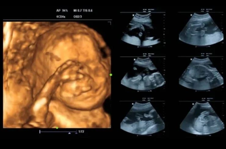 Ultrasound Scan